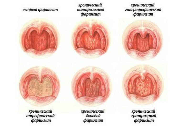 Types of Laryngitis